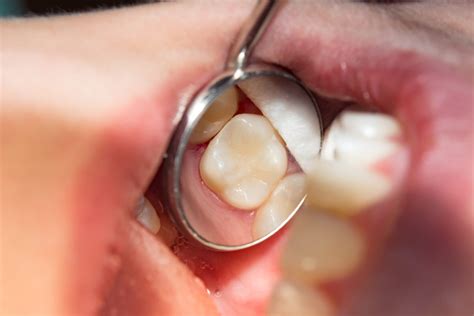cavity filling cost