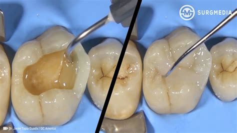 cavity filling