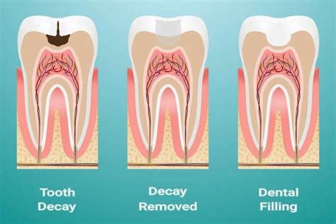 how long does it take to fill a cavity